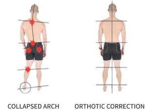 Graphic showing a before and after back arch orthotic correction
