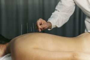 acupuncture treatment in Mississauga